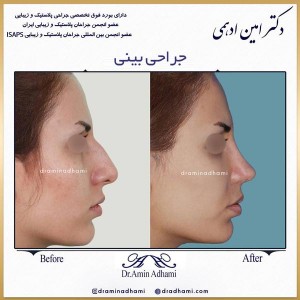 جراحی بینی