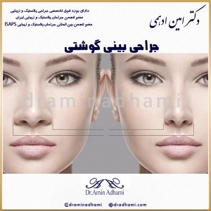 جراحی بینی گوشتی