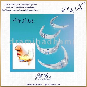 پروتز چانه
