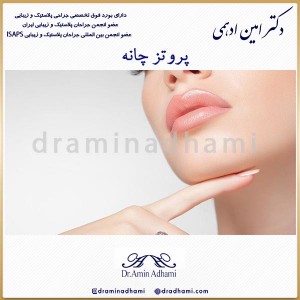 پروتز چانه