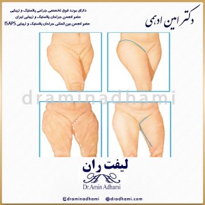 لیفت ران