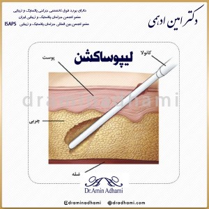 لیپوساکشن