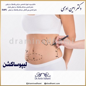 لیپوساکشن