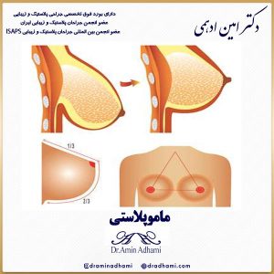 ماموپلاستی