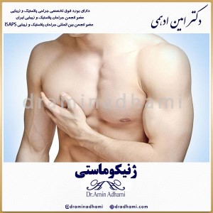 ژنیکوماستی