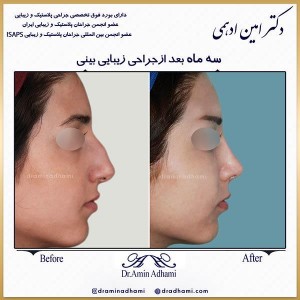 جراحی بینی استخوانی