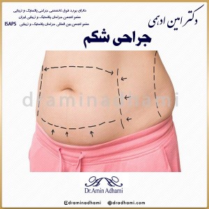 جراحی شکم