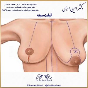 لیفت سینه